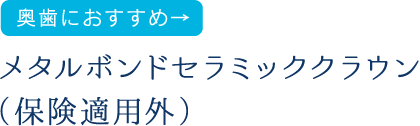 奥歯におすすめ メタルボンドセラミッククラウン（保険適用外）